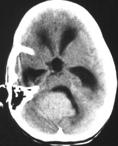 ependymoma-ct_scan.127174846_std